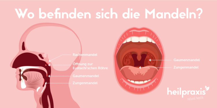 Schematische Darstellung eines Kopfes und eines geöffneten Mundes mit Kennzeichnung der Gaumen-, Rachen und Zungenmandeln.