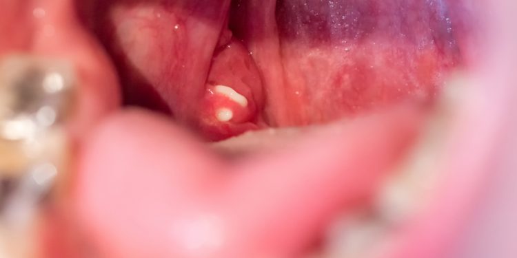 Foto eines geöffneten Mundes mit erkennbaren weißen Mandelsteinen auf den Gaumenmandeln.