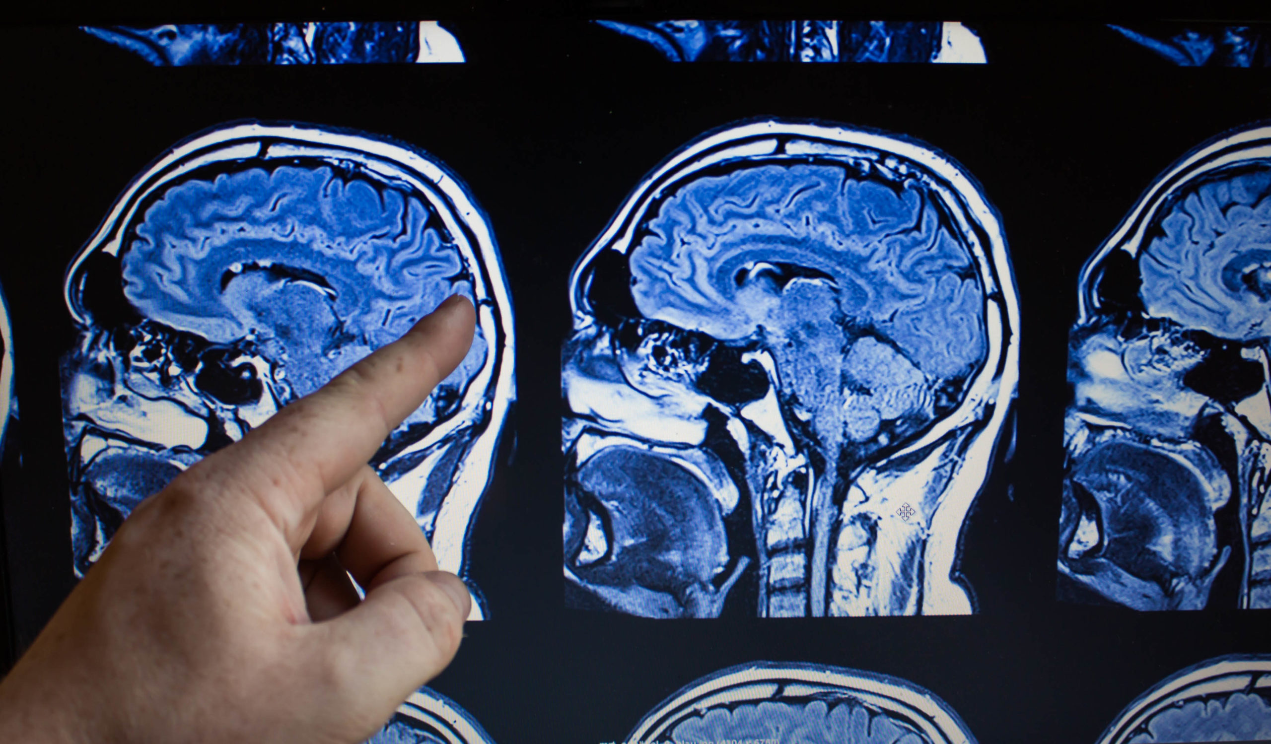 Gehirntumor: Diese wichtigen Warnzeichen sollte man kennen – Heilpraxis