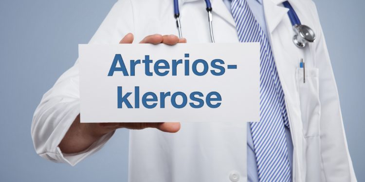 Mediziner zeigt ein Schild mit der Aufschrift Arteriosklerose