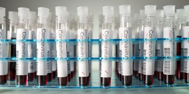 Mehrere mit Blut gefüllte Coronavirus-Test-Reagenzgläser