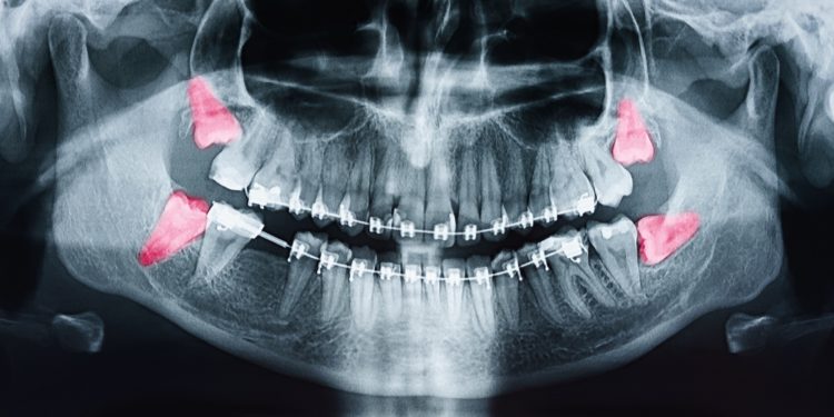 Röntgenaufnahme der Zähne mit rot markierten Weisheitszähnen.