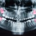 Röntgenaufnahme der Zähne mit rot markierten Weisheitszähnen.