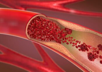 3D-Darstellung einer verengten und blockierten Arterie