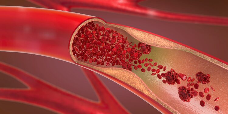 3D-Darstellung einer verengten und blockierten Arterie