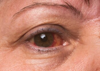 Nahaufnahme eines Auges einer Frau mit Bindehautentzündung