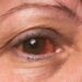 Nahaufnahme eines Auges einer Frau mit Bindehautentzündung