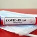 Wie zuverlässig ist der Einsatz von Antikörpertests zur Diagnose von COVID-19? (Bild: Joel bubble ben/Stock.Adobe.com)