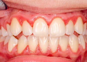 Zähne mit Zahnfleisch und Zahnfleischentzündung in Nahaufnahme.
