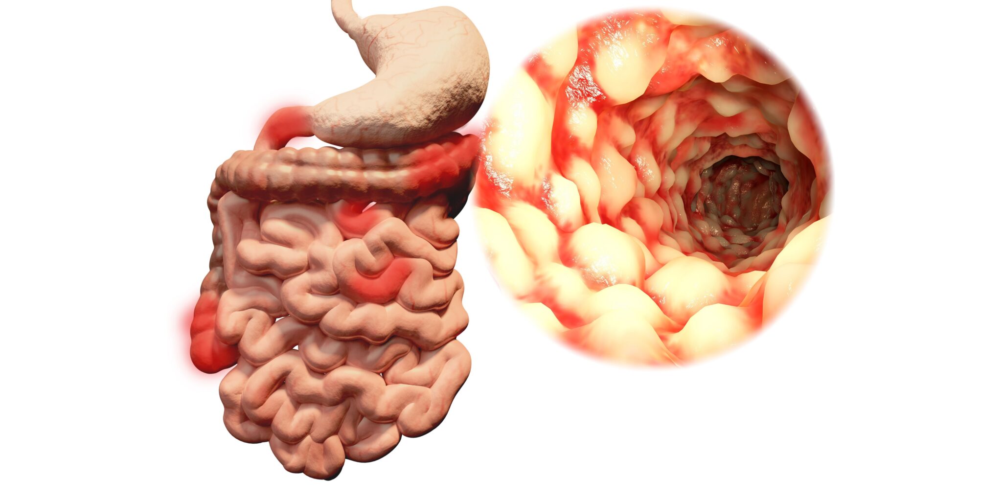 Kann Man An Morbus Crohn Sterben www.heilpraxisnet.de