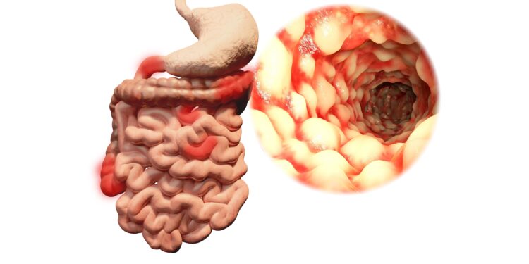 Darstellung eines Darms mit chronisch-entzündlicher Darmerkrankung.