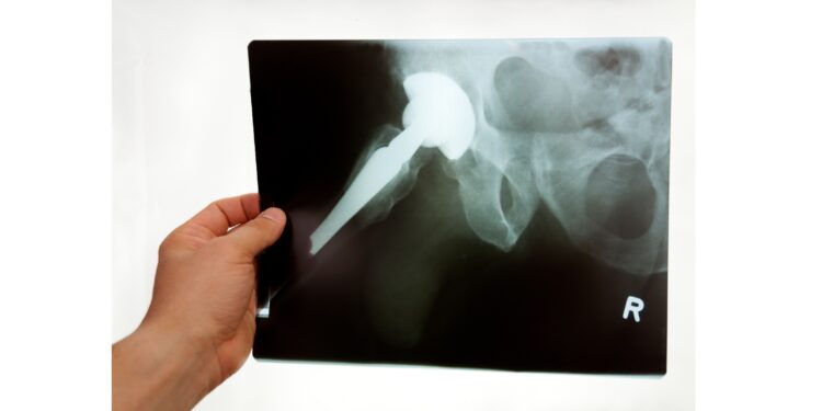 Ein Röntgenbild eines künstlichen Hüftgelenks