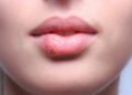 Herpes-Fieberbläschen an der Lippe einer jungen Frau