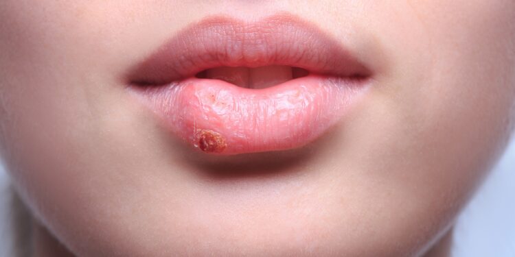 herpes herpes labial en el labio de una mujer joven