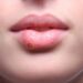 Herpes-Fieberbläschen an der Lippe einer jungen Frau