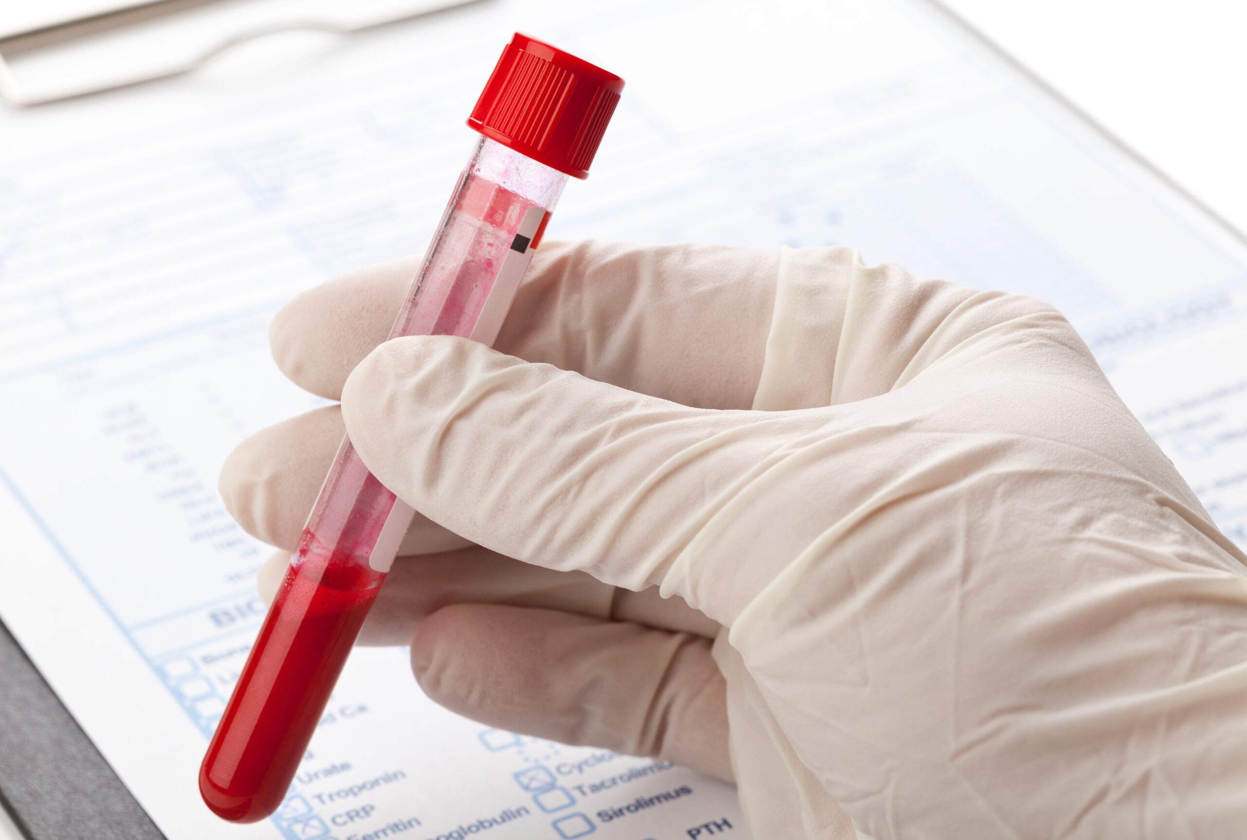 Un semplice esame del sangue predice in modo affidabile lo sviluppo del cancro al fegato: una pratica curativa