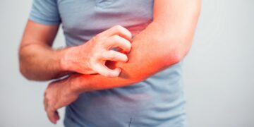Mann kratzt sich mit der rechten Hand am geröteten rechten Unterarm