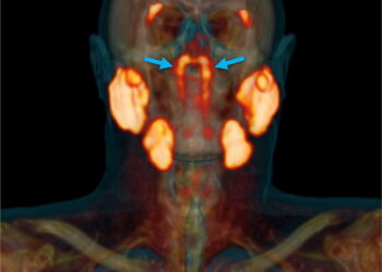 Ein Scan eines Kopfes, welches mittels dem Bildgebungsverfahren PSMA PET/CT aufgenommen wurde.