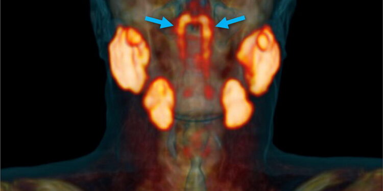 Ein Scan eines Kopfes, welches mittels dem Bildgebungsverfahren PSMA PET/CT aufgenommen wurde.