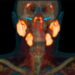 Ein Scan eines Kopfes, welches mittels dem Bildgebungsverfahren PSMA PET/CT aufgenommen wurde.