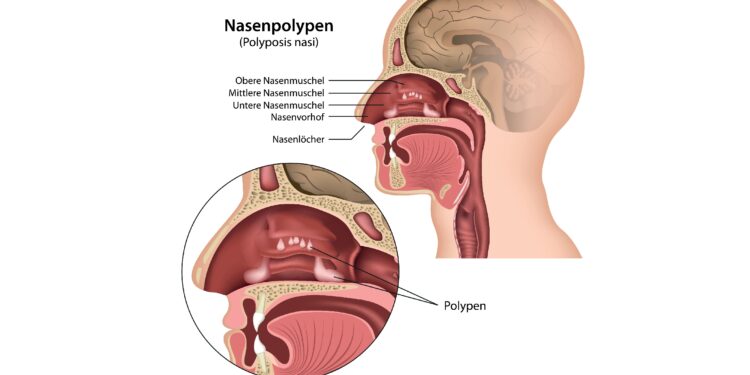 Ein Schaubild über Nasenpolypen (Polyposis nasi).
