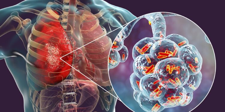 3D-Illustration einer bakteriellen Lungenentzündung