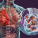 3D-Illustration einer bakteriellen Lungenentzündung