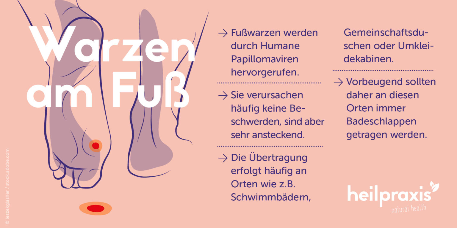 Was Tun Gegen Warzen Am Fuß www.heilpraxisnet.de