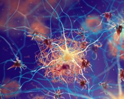 Grafische Darstellung von Amyloid-Plaques, die sich im Rahmen einer Alzheimer-Krankheit im Gehirn ablagern.