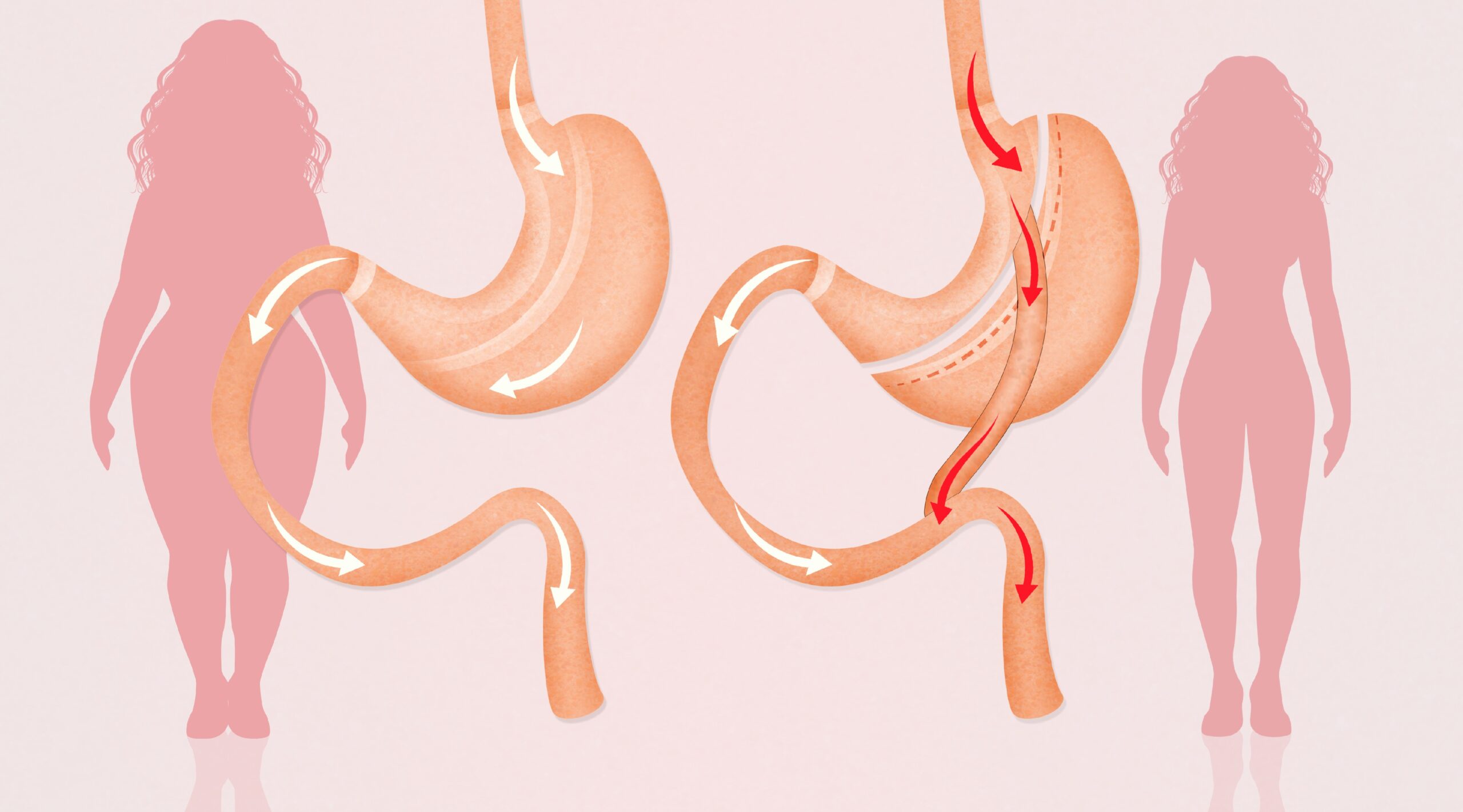 Бариатрическая Операция Цена К31