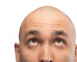 Mann schaut auf seine Glatze.