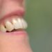 Zahnfleisch einer Person mit Parodontitis.