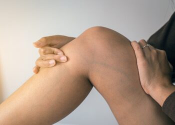 Frau hält ihre Hände an ihrem Bein mit Krampfadern