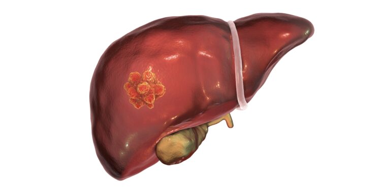 Grafische Darstellung einer Leber mit Tumor.