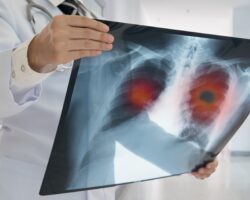 Ein Arzt hält ein Röntgenbild einer Lunge in der Hand.