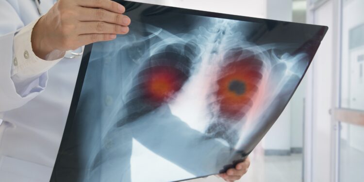 Ein Arzt hält ein Röntgenbild einer Lunge in der Hand.