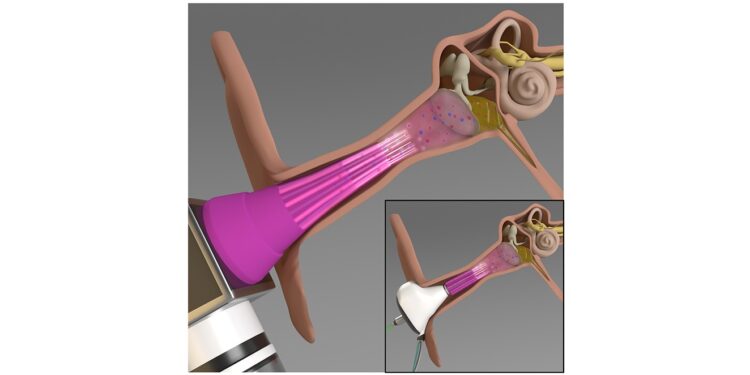 Zeichnerische Darstellung des Einsatzes von zwei neuen Geräten zur Behandlung von Mittelohrentzündungen.
