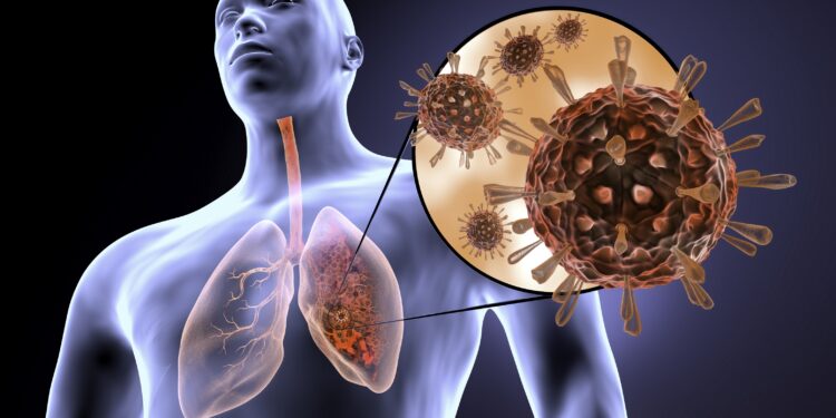 Schema di un polmone infetto dal virus Corona.