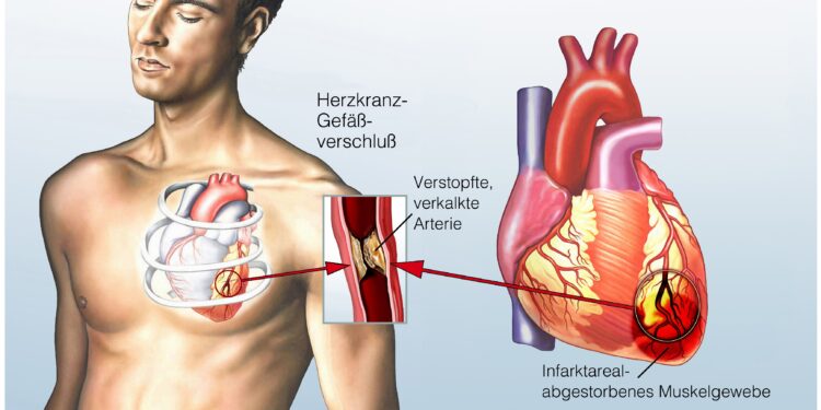 Schaubild Angina Pectoris.