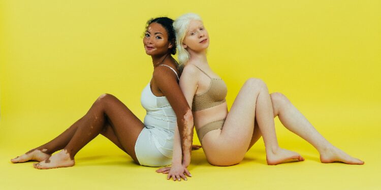 Frau mit Albinismus und Frau mit Weißfleckenkrankheit sitzen Rücken an Rücken vor einem gelben Hintergrund
