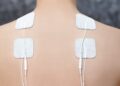 Vier weiße Elektrodenpflaster im Schulter-Nacken-Bereich