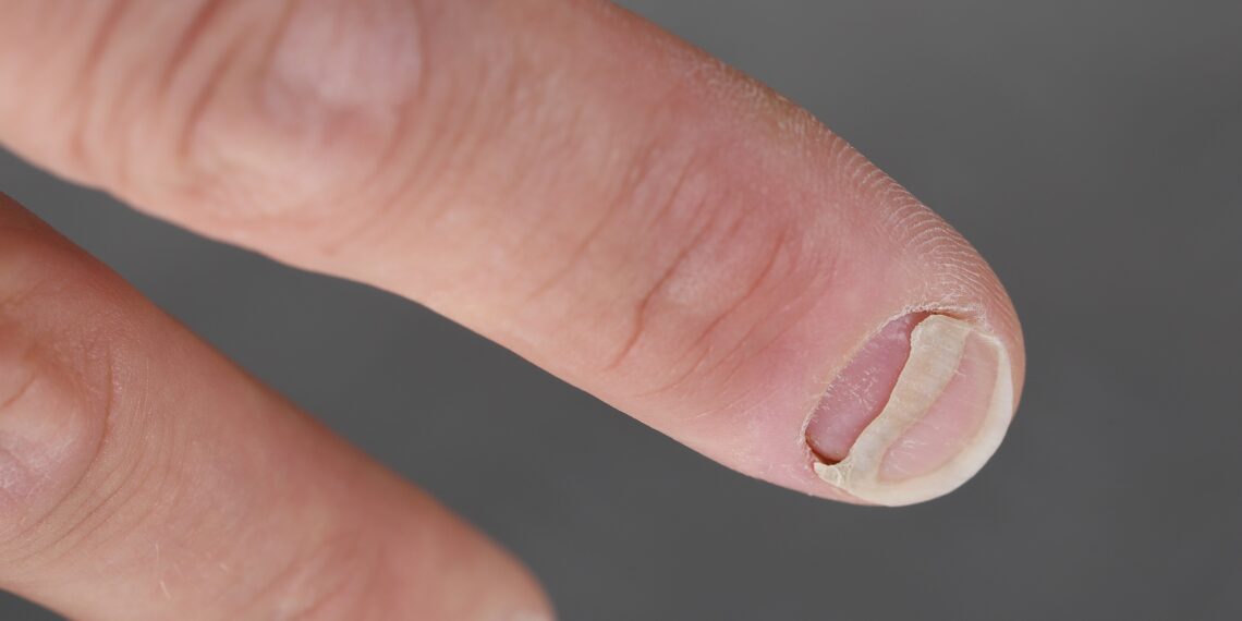 Fingernagel Löst Sich Nach Quetschung Ab Nagelablösung – Ursachen und Behandlung – Heilpraxis