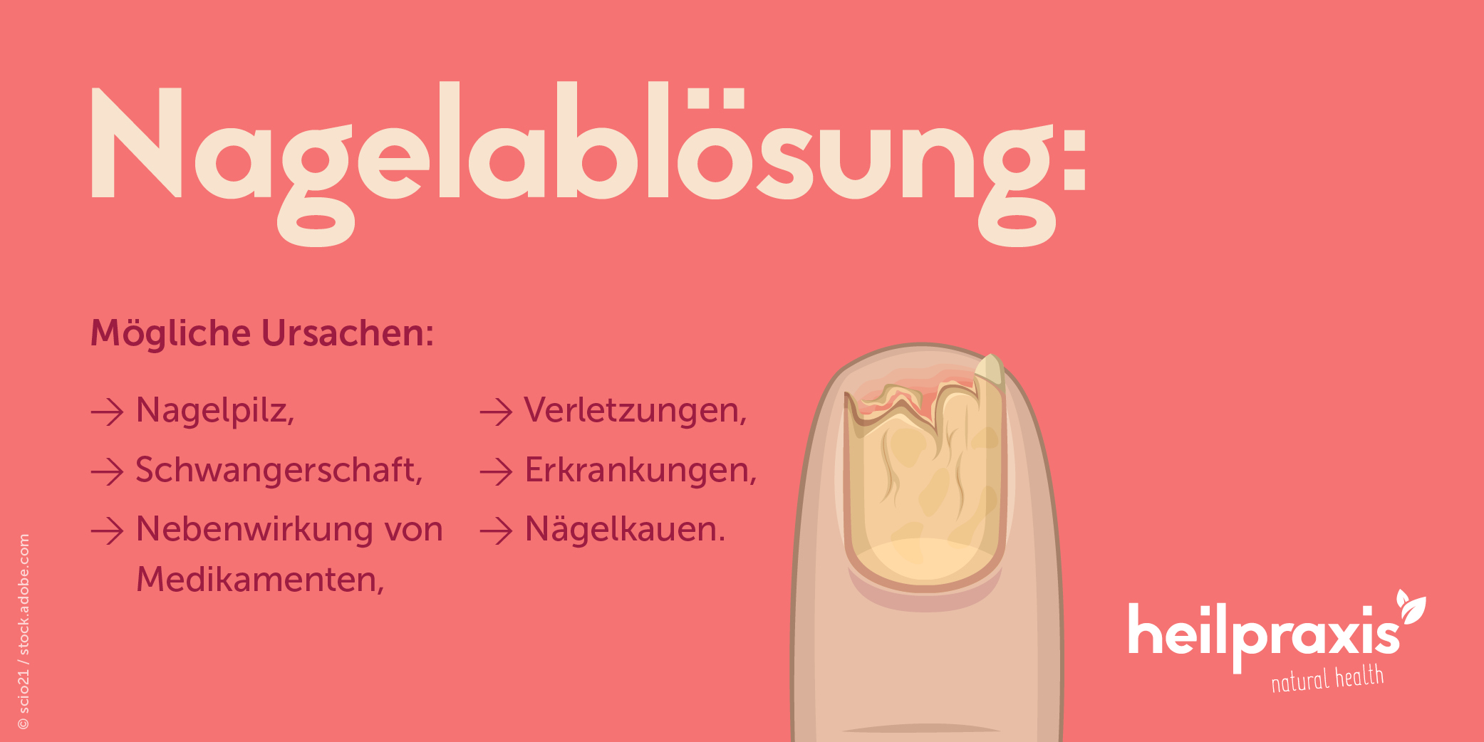 Ursachen für Nagelablösung