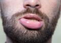 Eine geschwollene Lippe ist zwar unangenehm, aber bildet sich oft von alleine wieder zurück. (Bild: Jessmine/stock.adobe.com)