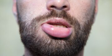 Eine geschwollene Lippe ist zwar unangenehm, aber bildet sich oft von alleine wieder zurück. (Bild: Jessmine/stock.adobe.com)