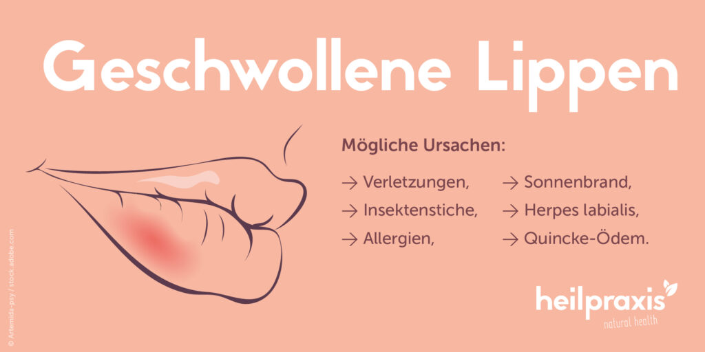 Geschwollene Lippen Ursachen und Hausmittel Heilpraxis