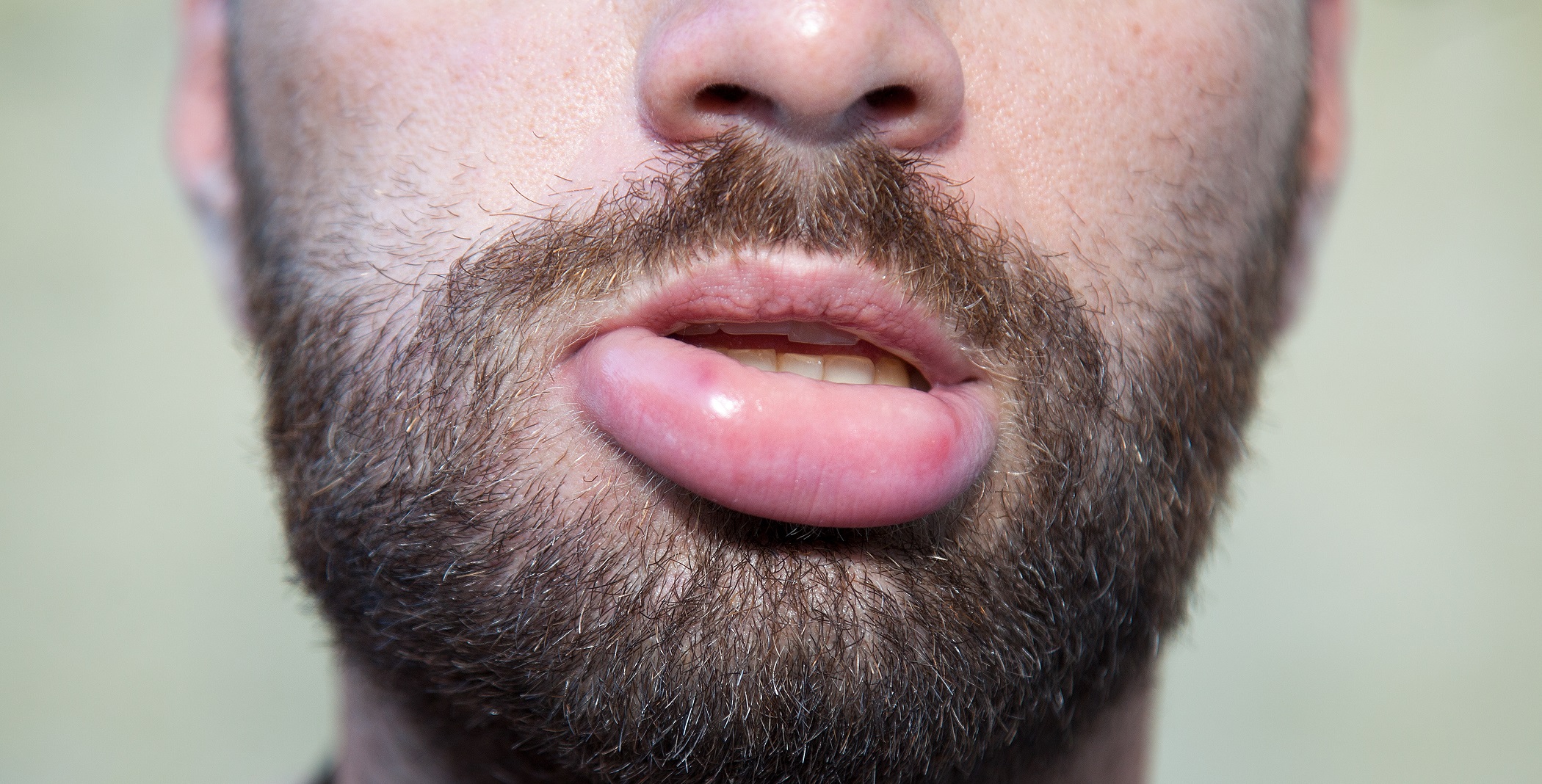 Geschwollene Lippen Ursachen und Hausmittel Heilpraxis