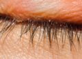Schuppen am Wimpernrand sowie häufiger Juckreiz können ein Hinweis auf einen Augenmilbenbefall sein. (Bild: ohishiftl/stock.adobe.com)