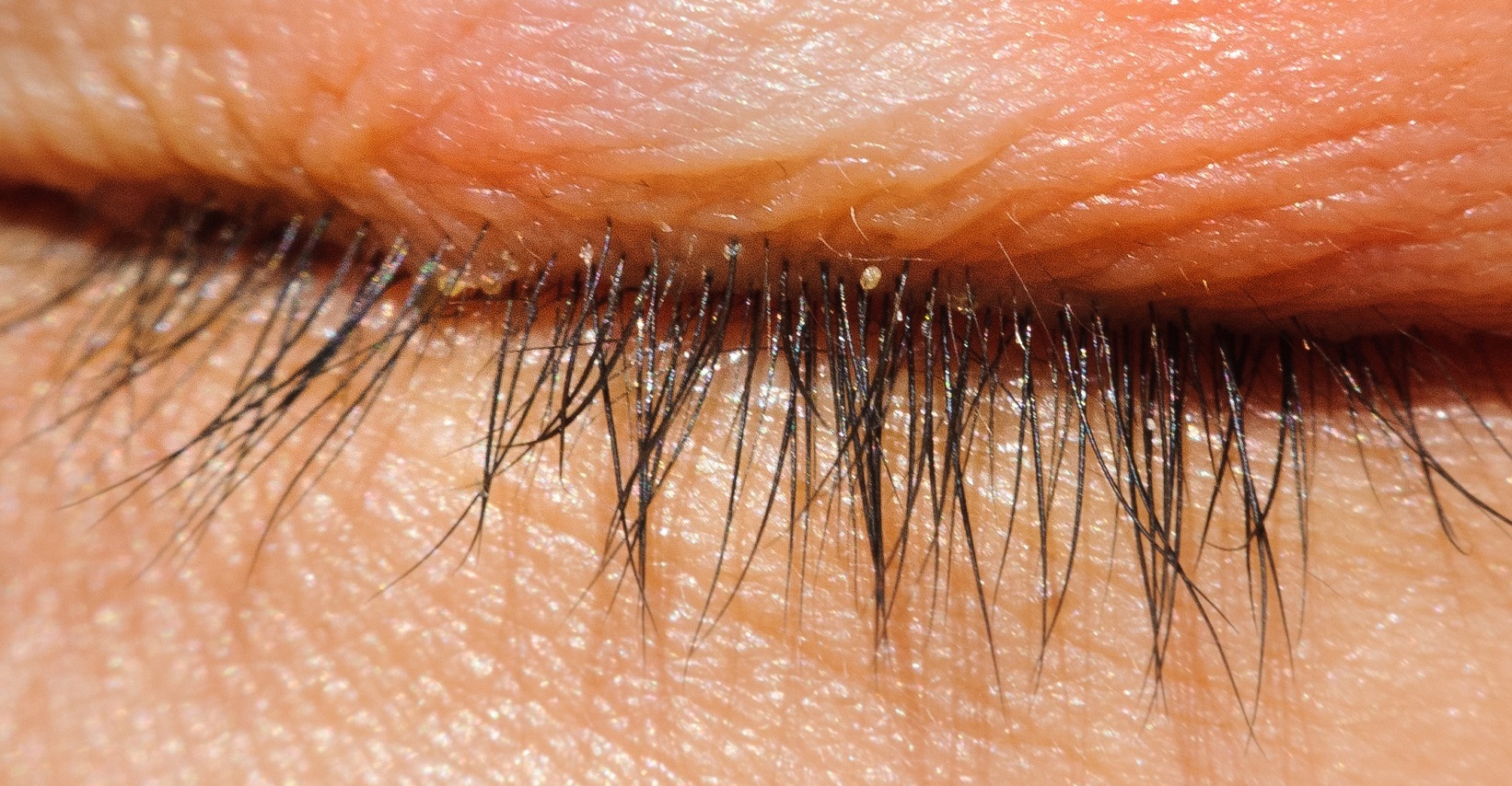 Augenmilben Ursachen, Symptome und Behandlung Heilpraxis
