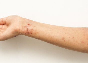 Ein Symptom einer Zinkallergie kann Hautausschlag sein. (Bild: Diliara/stock.adobe.com)